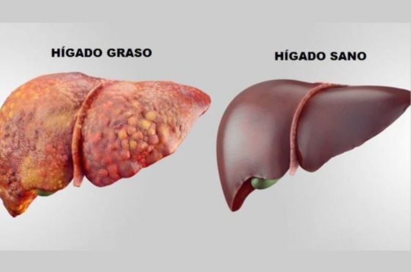 Alimentos que debes evitar si padeces hígado graso