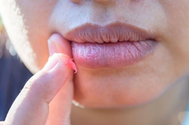 Cómo proteger tus labios y evitar la resequedad: ocho consejos prácticos