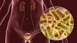 Cistitis: ¿Por qué esta infección urinaria afecta más a las mujeres y cómo evitarla?